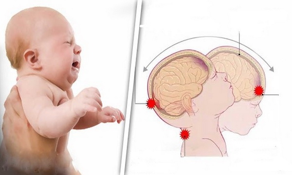 Shaken Baby Syndrome neoneti scossi