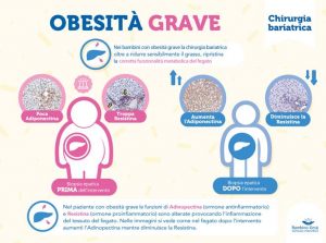 fegato grasso chirurgia bariatrica