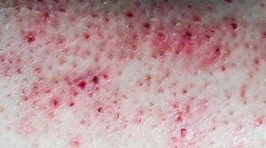 Dermatillomania