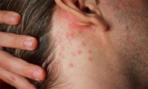 eczema topica