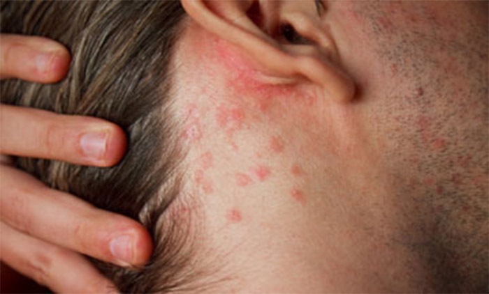 eczema topica