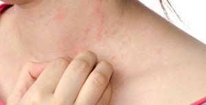 allergia al nichel