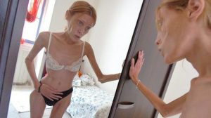 anoressia 
