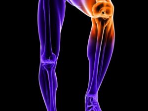 osteoartrosi