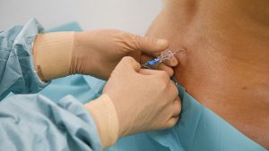 epidurale