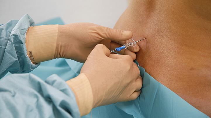 epidurale