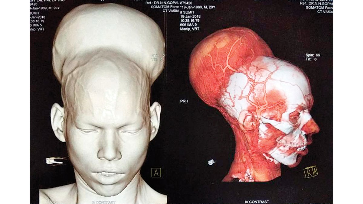 tumore cervello india
