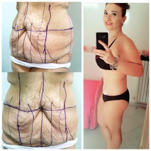 dieta virginia chirurgia plastica