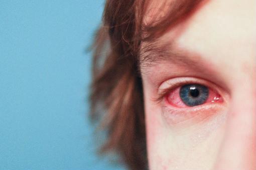 prurito occhi allergia rimedi congiuntivite allergica