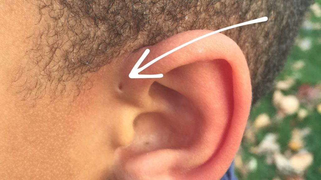 Preauricular Sinus