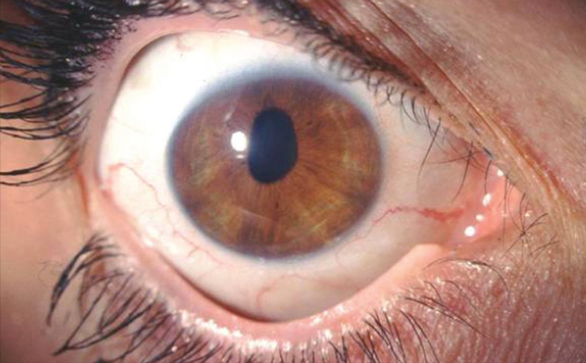 patologia occhio