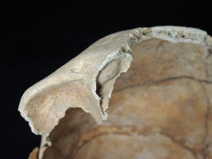 osteoblastoma