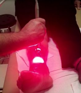 ulcera theal therapy