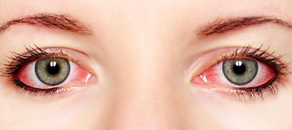 Sindrome di Sjögren