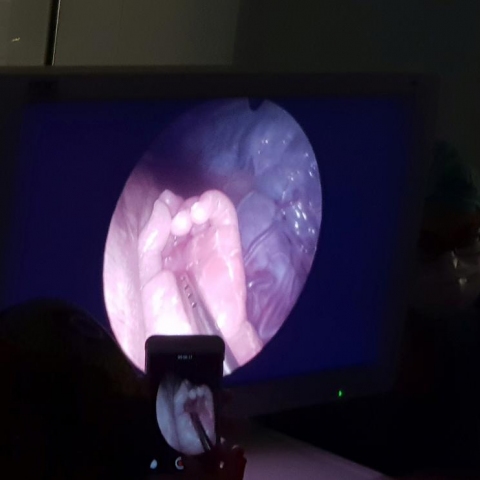 Spina bifida curata in utero, al Policlinico di Milano primo intervento d'Europa