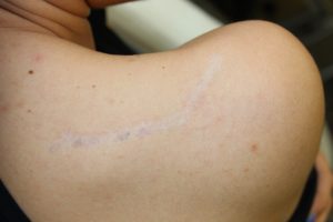 tatuaggi rimozione