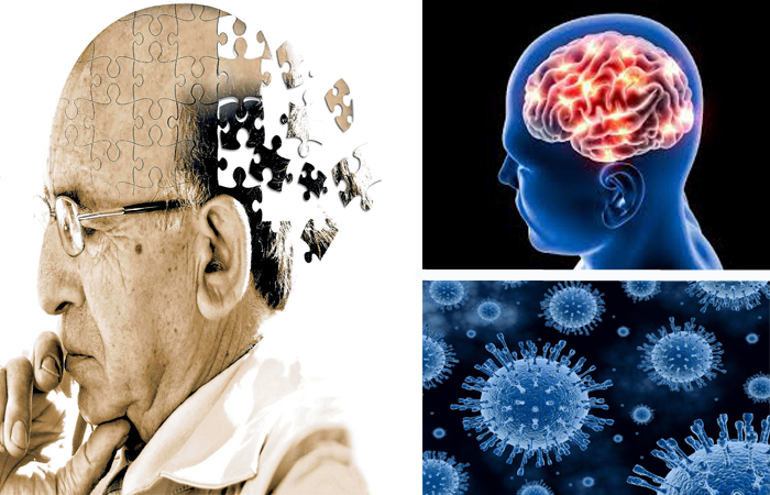 herpes virus alzheimer