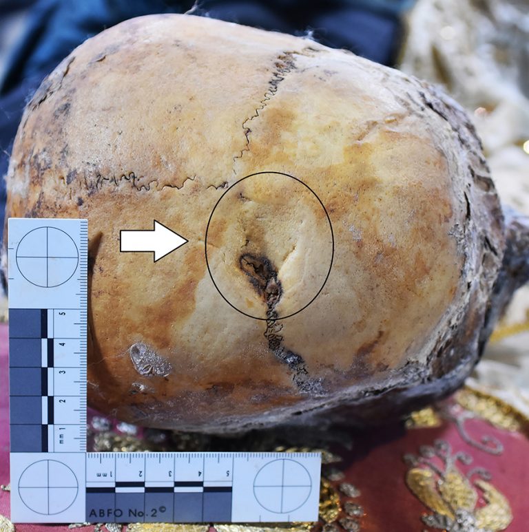 Il cranio di San Davino con in evidenza la lesione che mostra i segni del cauterio pentagonale