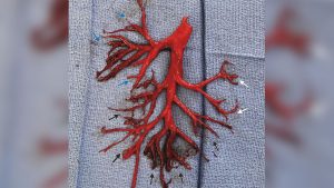tossisce forte albero bronchiale
