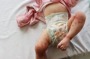 baciare bambini herpes