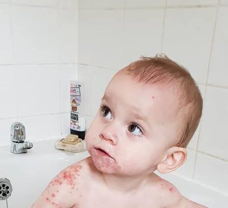 baciare bambini herpes
