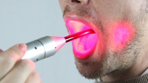 Laser per l'igiene orale