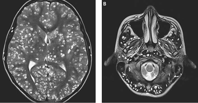 larve cervello neurocisticercosi