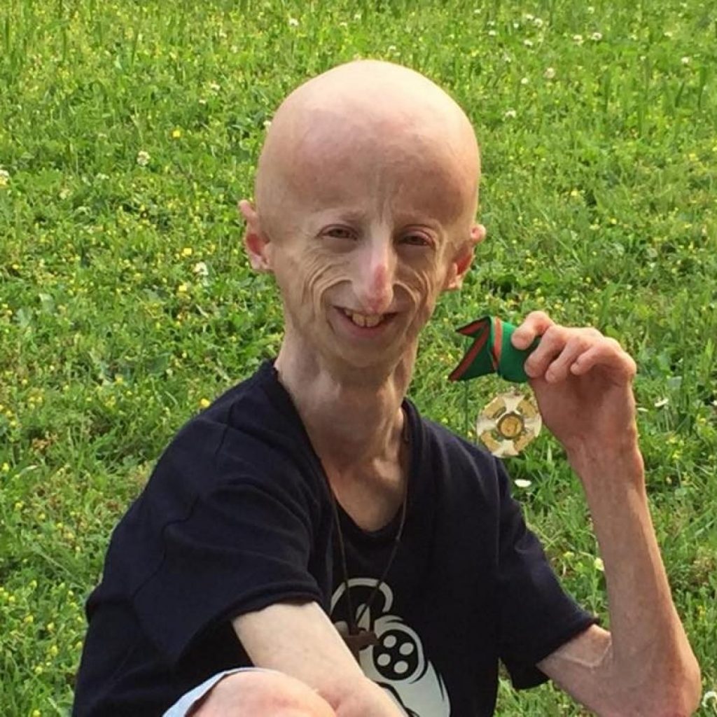 sammy basso progeria