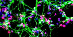 Malattie neurodegenerative spazio