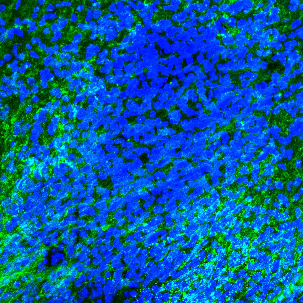 Sclerosi multipla nuova luce sul ruolo della microglia nella riparazione della mielina