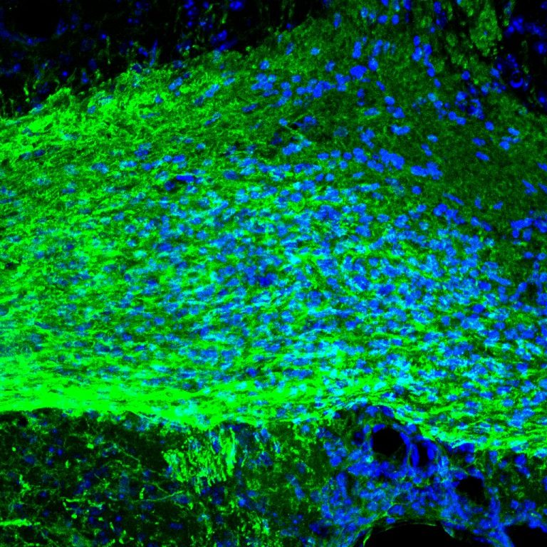 Sclerosi multipla nuova luce sul ruolo della microglia nella riparazione della mielina