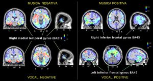 Attivazioni cerebrali registrate durante l’ascolto di musica (positiva o negative), e vocalizzazioni (positive e negative)