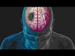 edema cerebrale cervello