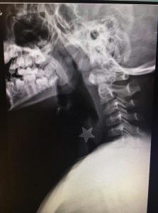 stella metallo trachea niguarda