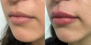 filler labbra