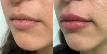 filler labbra