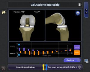 protesi ginocchio con robot