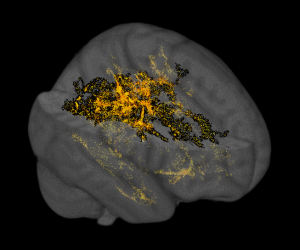 aree della sostanza bianca colpite dall’infiammazione con intensita diversa_colori da scuro a brillante
