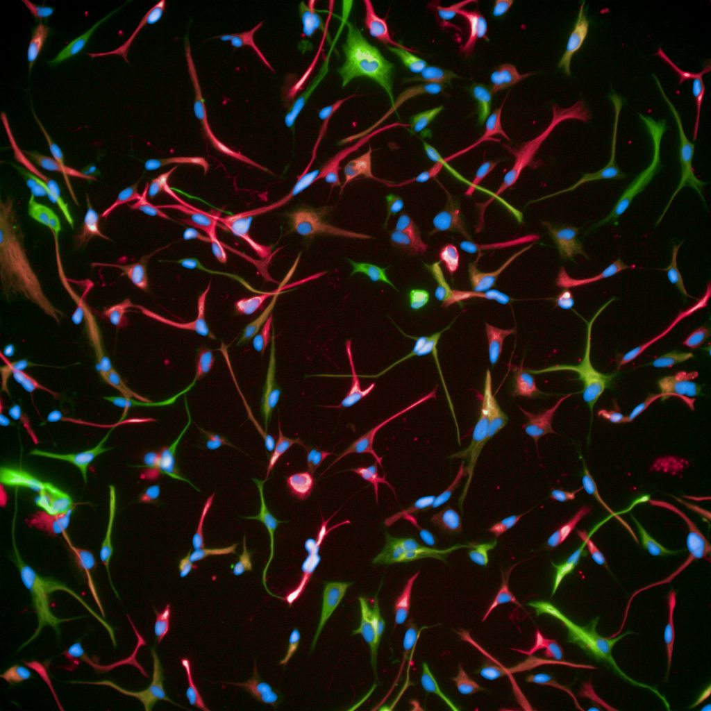 Cellule t - Glioma Diffuso della Linea Mediana