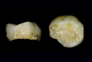 Dente unibo