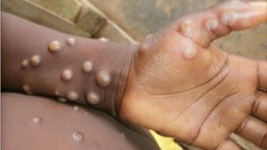 monkeypox vaiolo delle scimmie