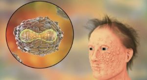 virus vaiolo delle scimmie
