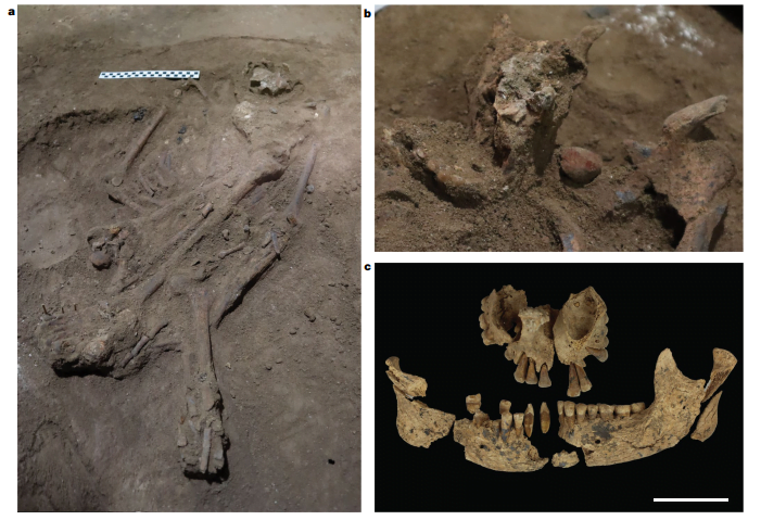 Più antica amputazione chirurgica