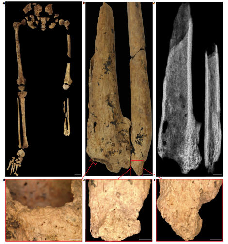 Più antica amputazione chirurgica