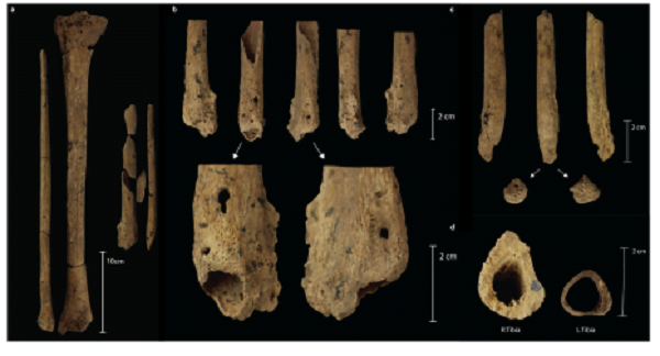 Più antica amputazione chirurgica