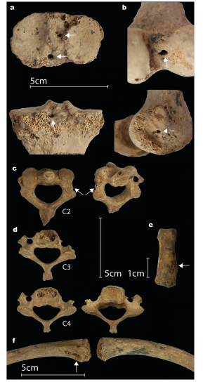 Più antica amputazione chirurgica