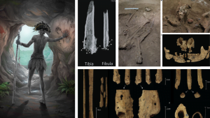 Più antica amputazione chirurgica