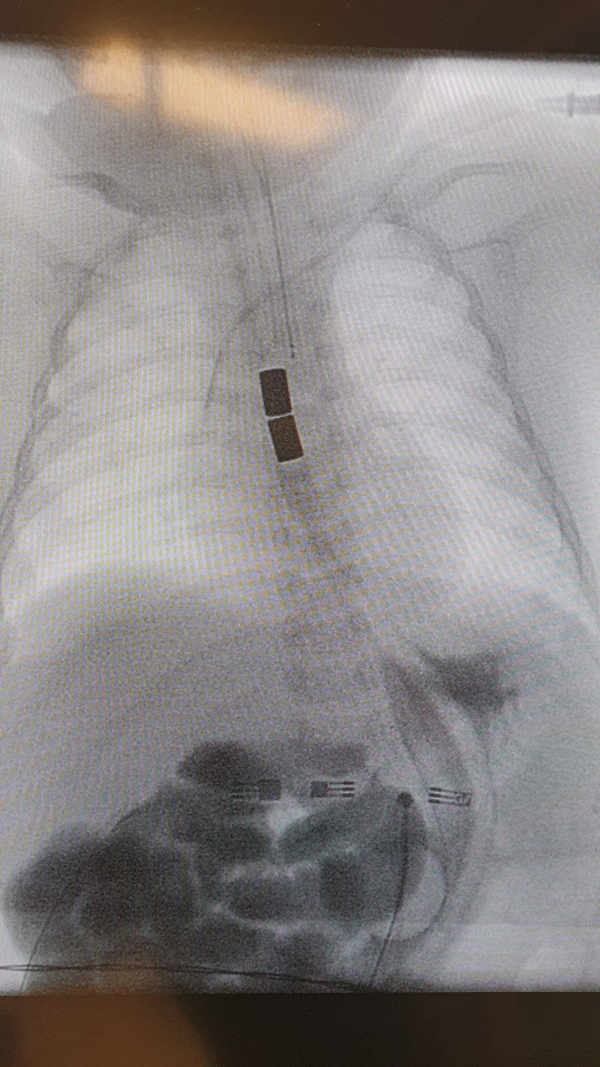 radiografia magneto anastomosi