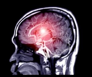 Stroke