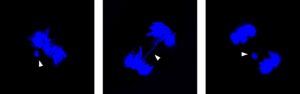 osteosarcoma cnr